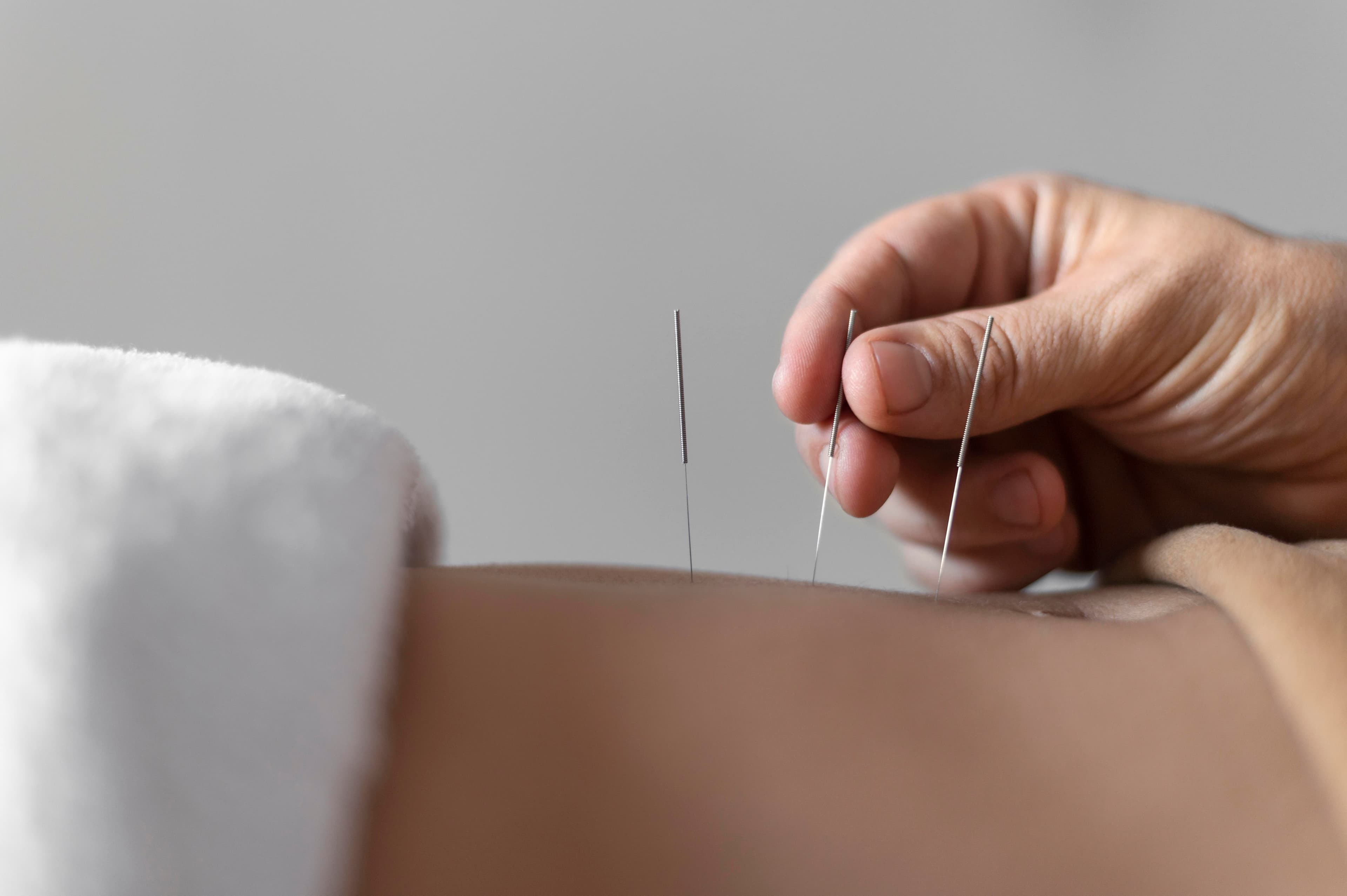 Dry Needling Therapy